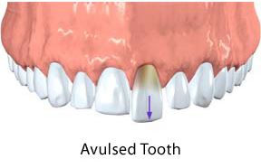 Your Child's Tooth is Knocked Out. Do You Know What To Do?