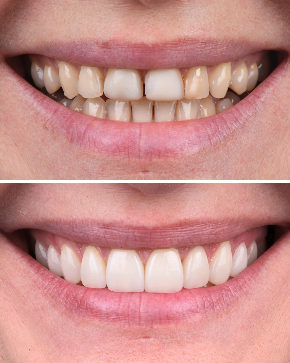 Antes e Depois da Paciente Kamila - Edson (2).png