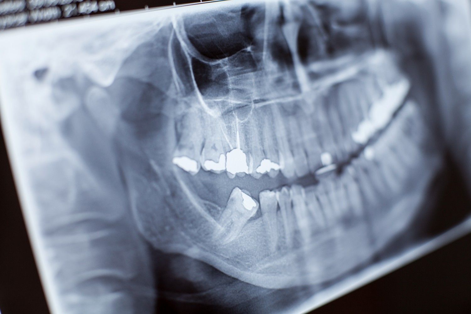 Newtown Elite Dental care for root canal treatment