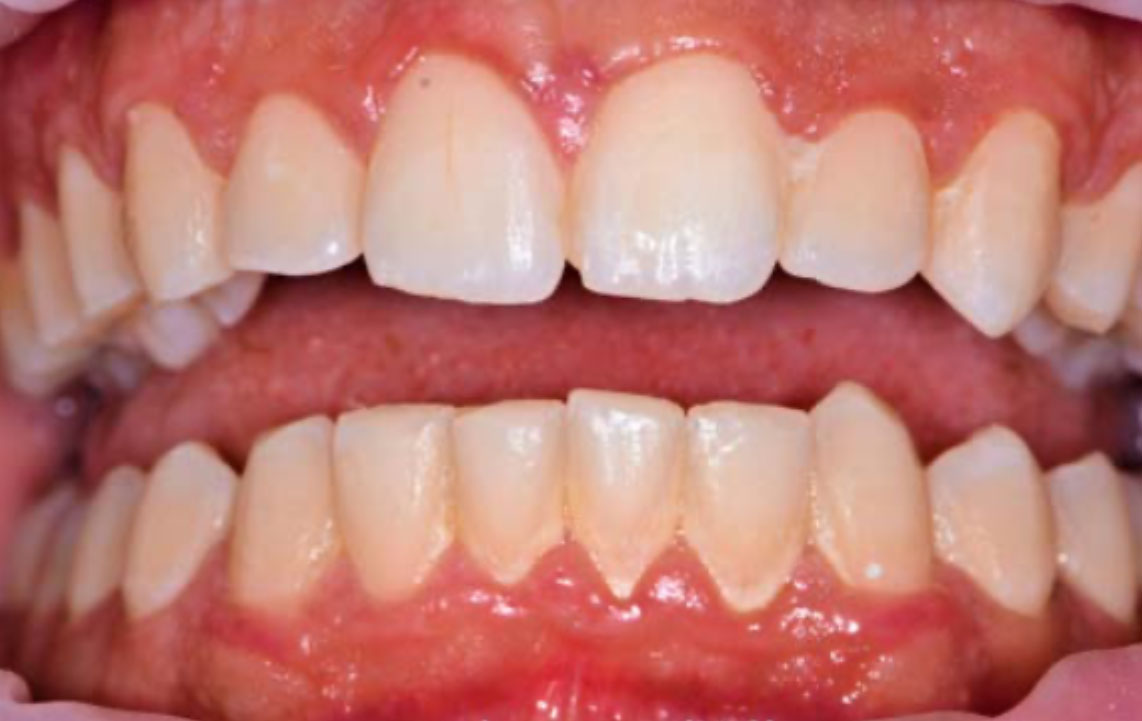 Before Dental maintenance and cleaning Cleaning Guided Biofilm Newtown Elite Dental