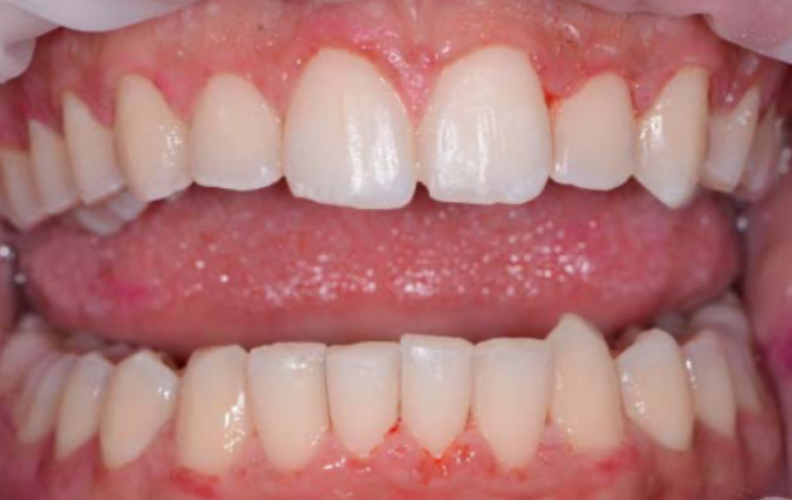 After Dental maintenance and cleaning Cleaning Guided Biofilm Newtown Elite Dental