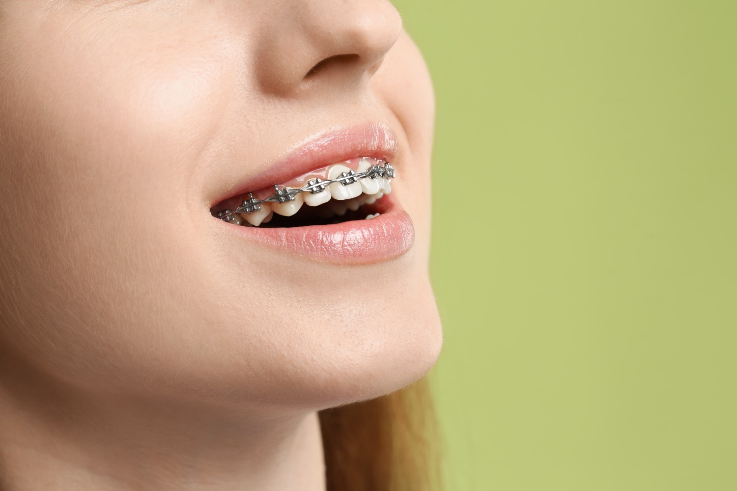 Invisalign vs Braces: Which Is Better? — article illustration 2