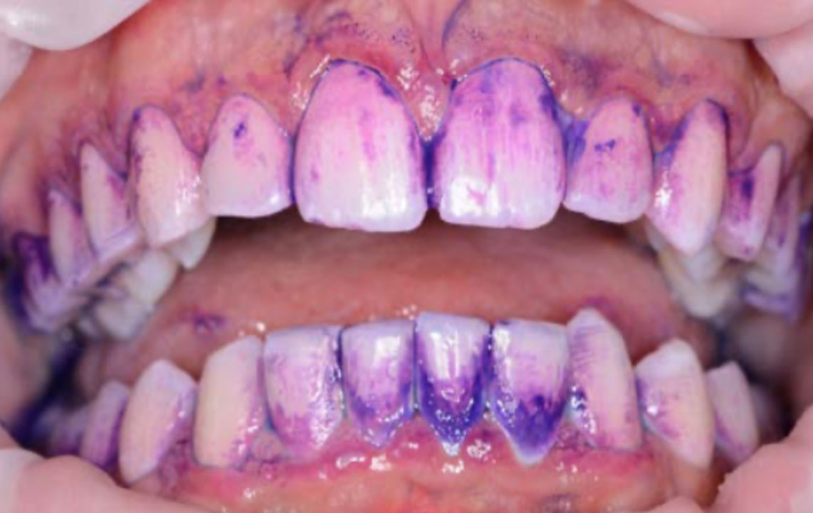 During Dental maintenance and cleaning Cleaning Guided Biofilm Newtown Elite Dental