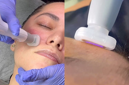 Jet Plasma Pen Performing Treatment