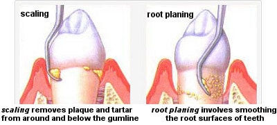 scaling_and_root_planing.jpeg