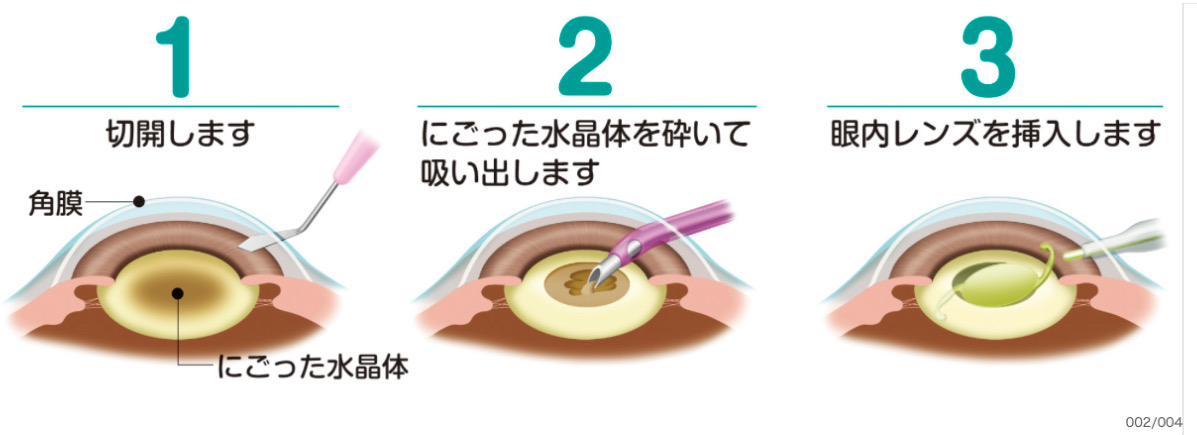 白内障の手術内容