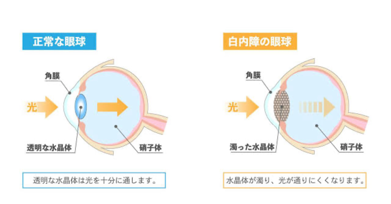 正常な眼球と白内障の眼球の違い
