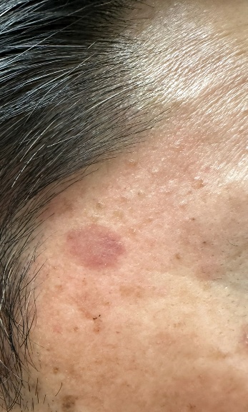 シミ改善（施術前）