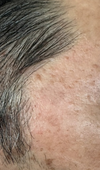 シミ改善（施術後）