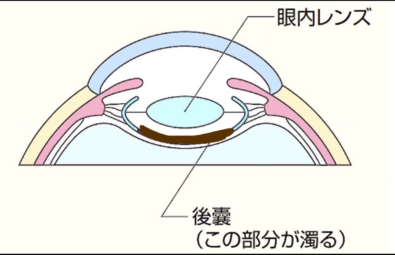 白内障の眼球の断面図