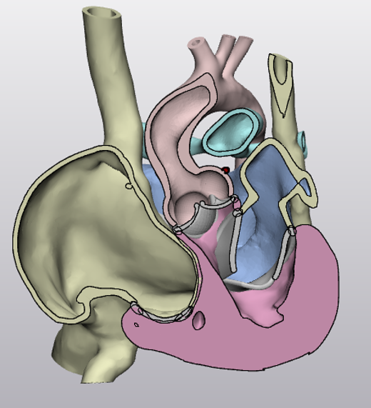 Thumbnail: Supravalvular AS and Severe PA Stenosis