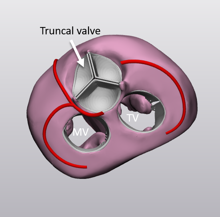 Thumbnail: Truncus Arteriosus