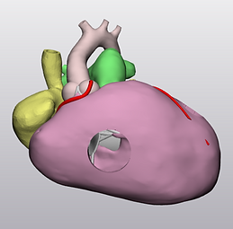 DORV with Remote Subaortic