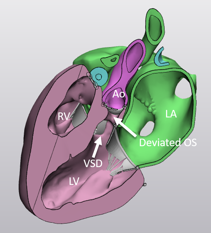 Thumbnail: Interrupted Aortic Arch