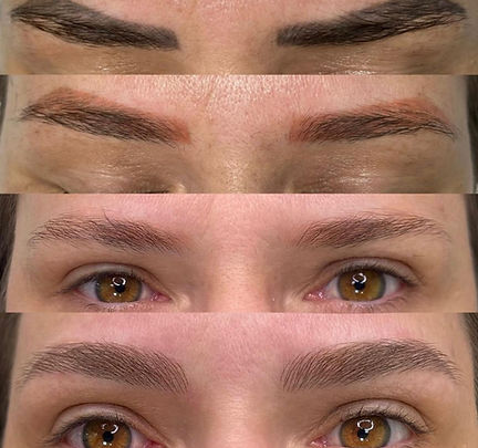 Laser tattoo removal (4).jpeg