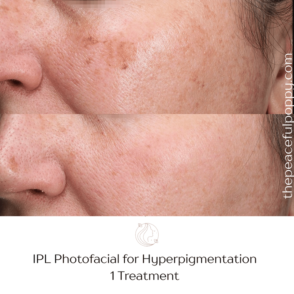 Before and after of IPL photofacial for hyperpigmentation at The Peaceful Poppy Med Spa at Longmont, CO