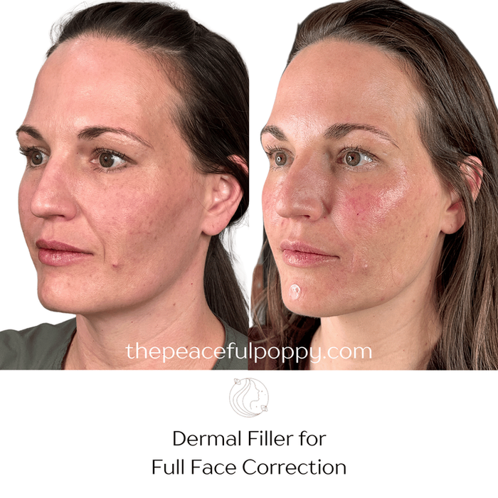 before and after of dermal filler for full face correction 