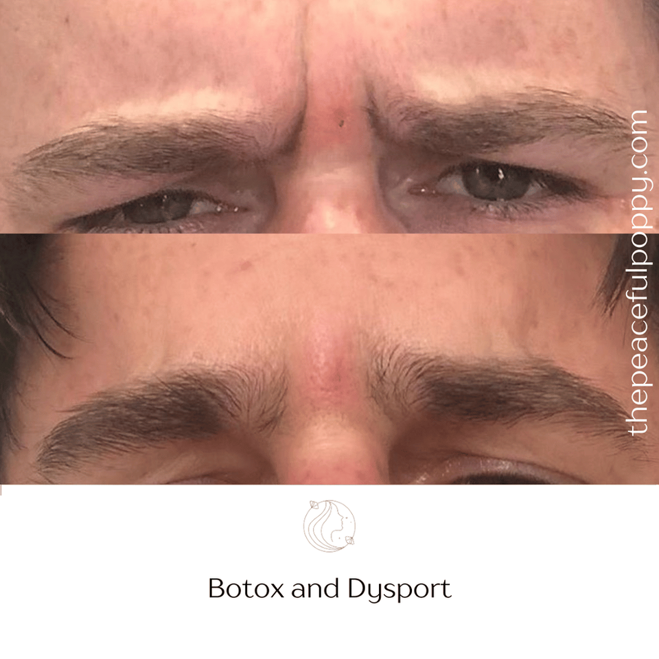 Botox and Dysport before and after