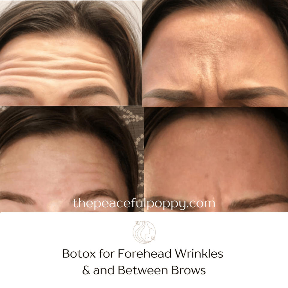 Botox before after for forehead wrinkles and for 11 wrinkles between brows