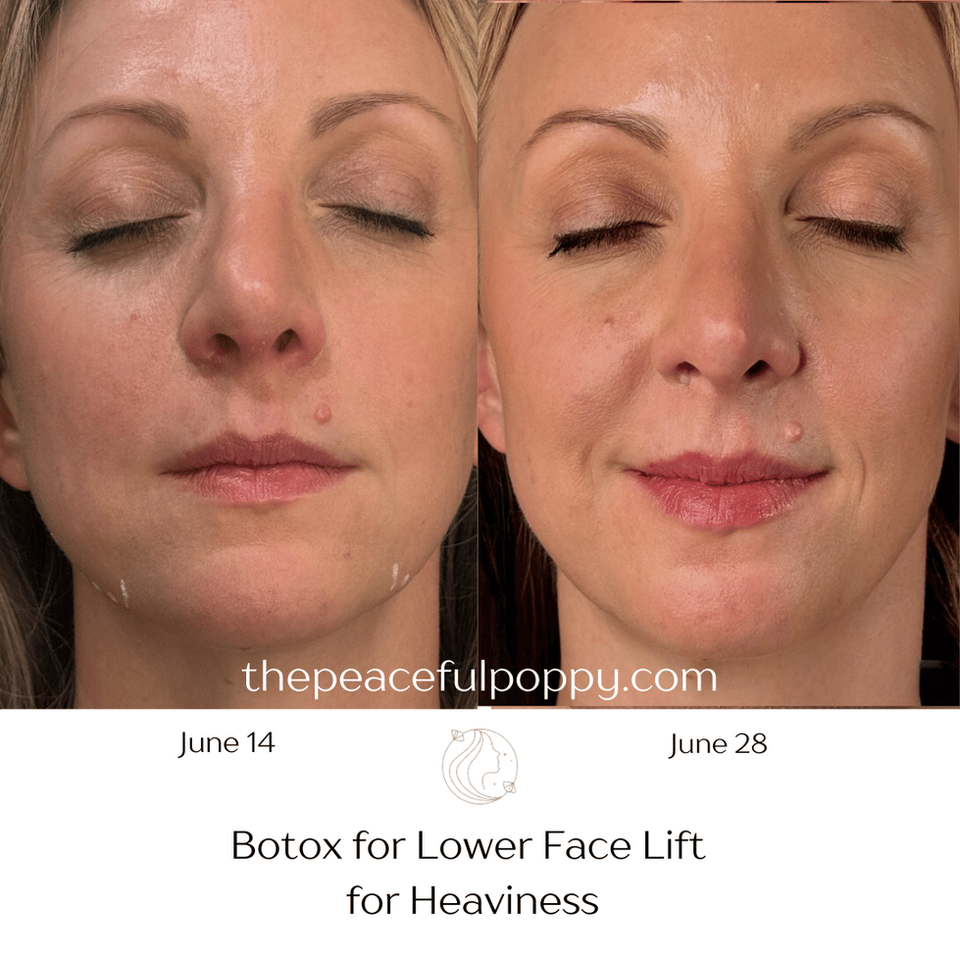 botox before and after for lower face life for heaviness