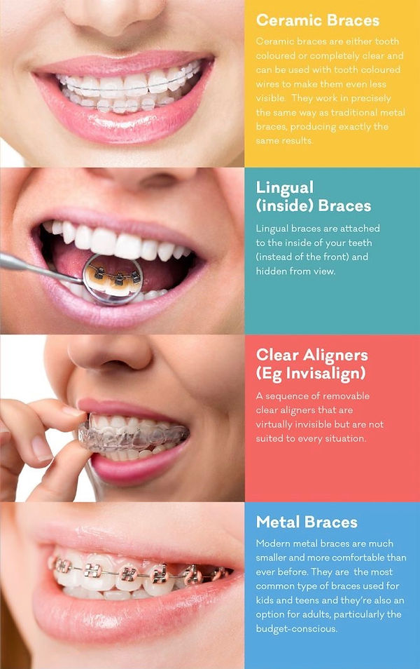 braces-options