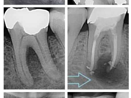 Everything You Need to Know About Teeth X-rays: Benefits, Process, and Frequency