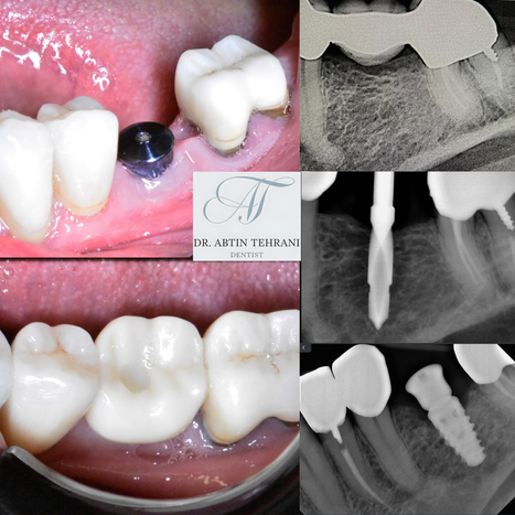 Photo collage of a case demonstrating different steps in tooth replacement with an implant