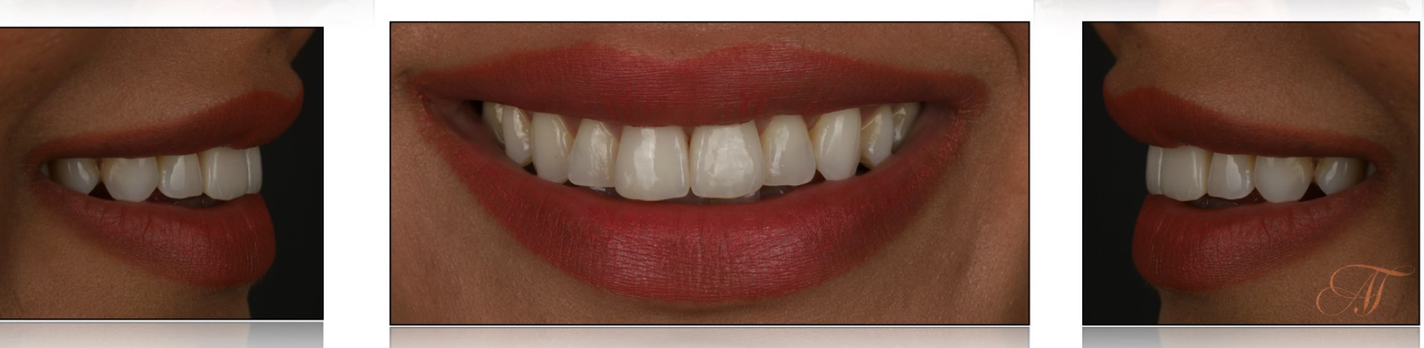 Close-up smile make-over photos showing final results from different sides (right side, front, and left side)