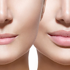 Dermal Fillers