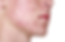 acne-1