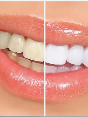Professional Teeth Whitening