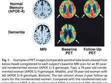 Diseases Over Decades: Alzheimers
