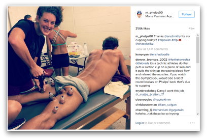What Are The Purple Dots On Michael Phelps? Cupping Has An Olympic Moment blog article by Gretchen Reynolds and Karen Crouse