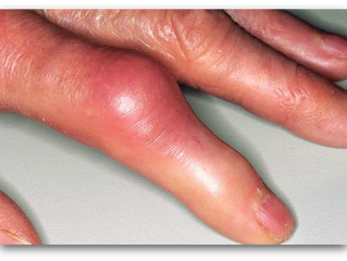 Alternative Remedies For Joint Pain, Gout & Arthritis