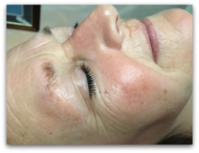 Jane Goodman's Cosmetic Acupuncture: Before #4