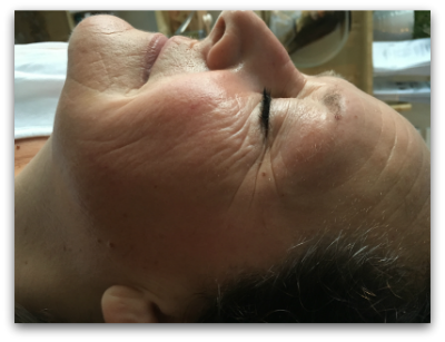 Jane Goodman's Cosmetic Acupuncture: Before #2