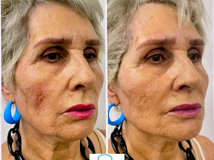 Sculptra bioestimulador de colágeno