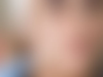 ¿Qué es mejor: Ácido Hialurónico o Botox?