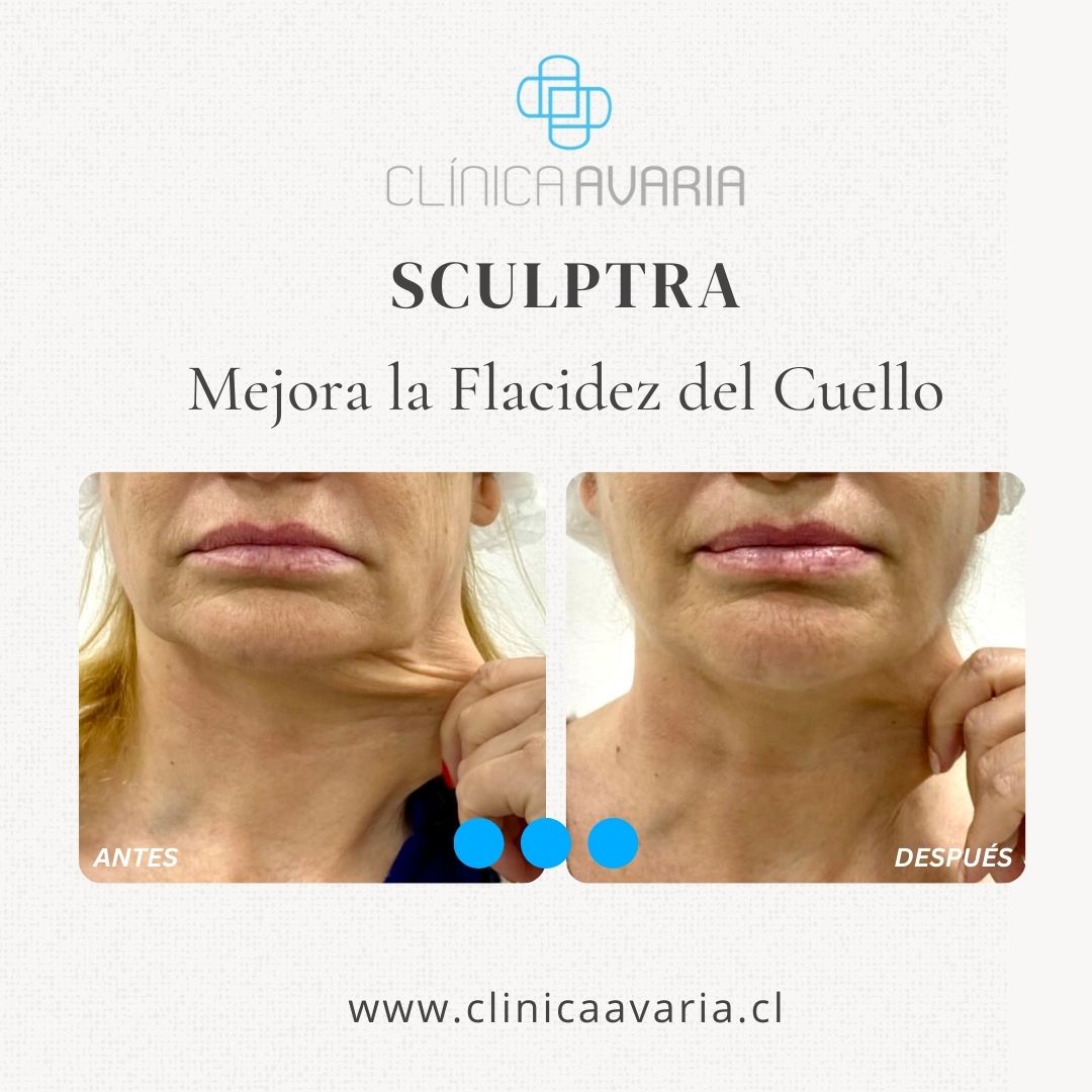 Antes y después de cuello de Sculptra