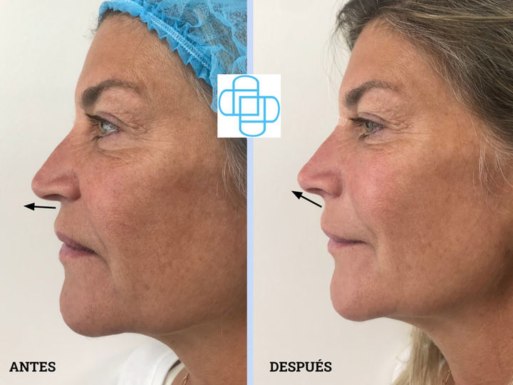 Rinomodelación con Ácido Hialurónico