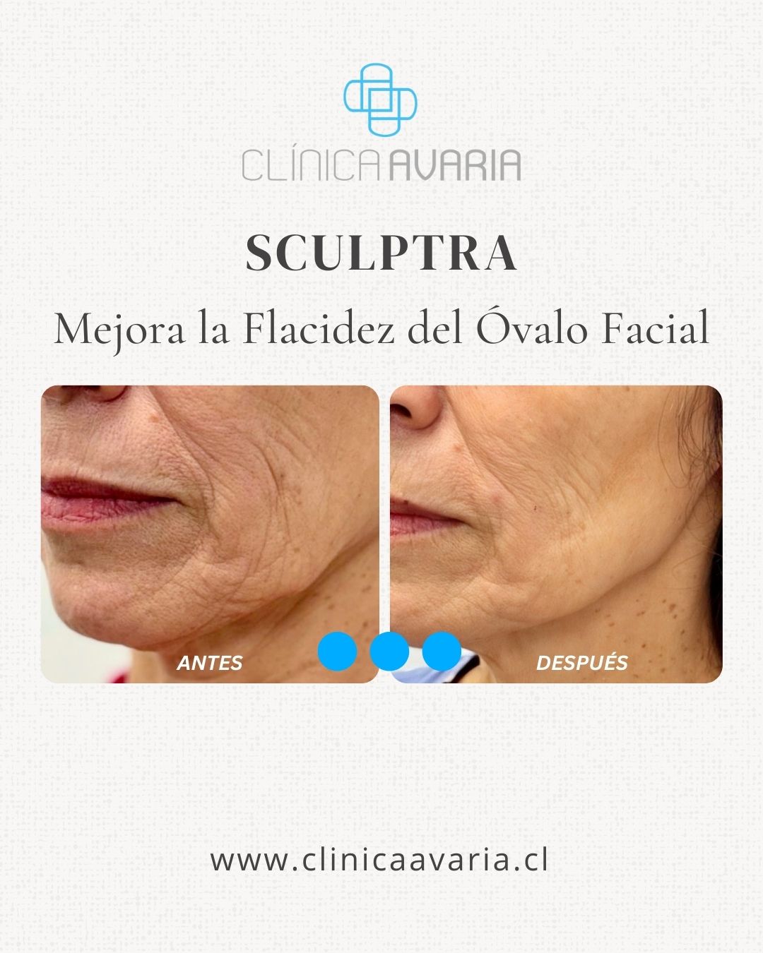 ANTES Y DESPUÉS DE SCULPTRA