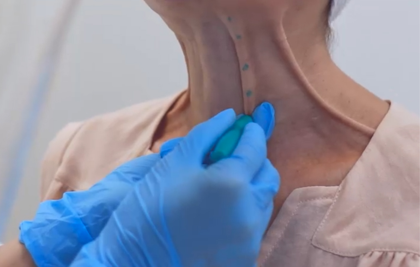 Botox en el cuello: el tratamiento que no sabías que existía