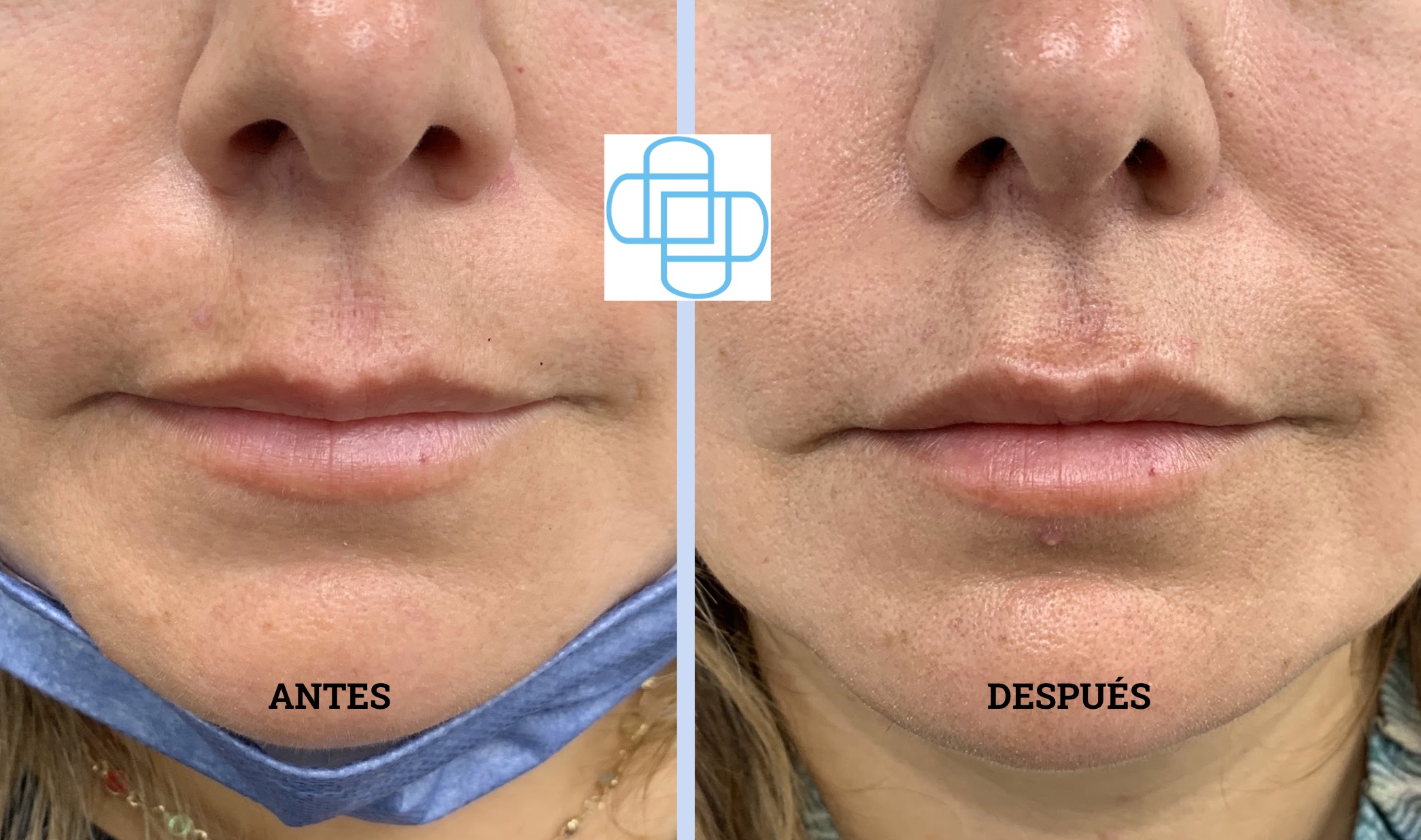 Descubre el Poder del Ácido Hialurónico en los Labios: Explorando Diversas Técnicas de Relleno
