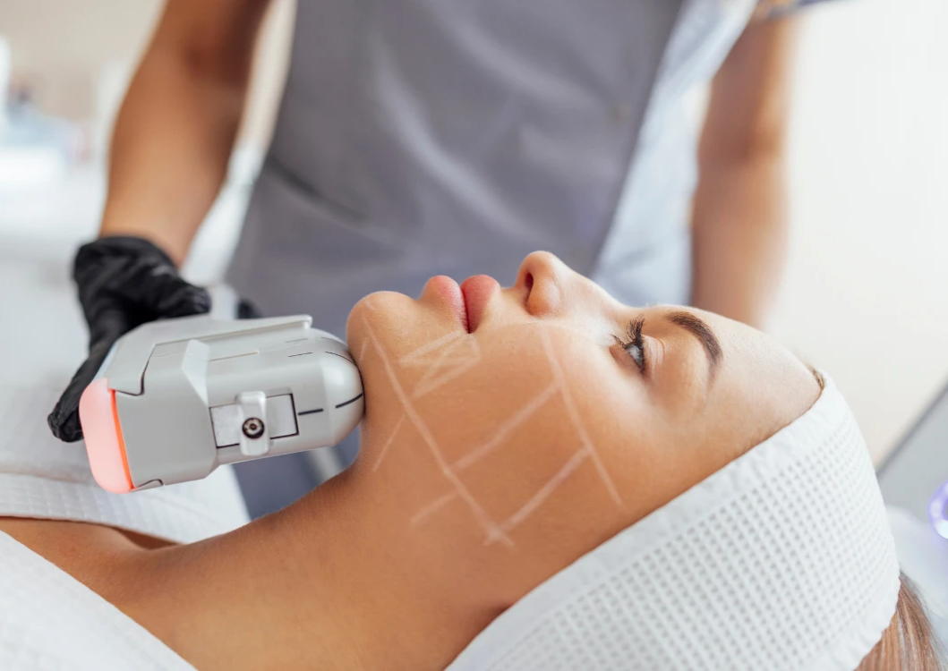 ¿Eres candidato para HIFU Liftera? Descubre el lifting sin cirugía que está revolucionando la estética