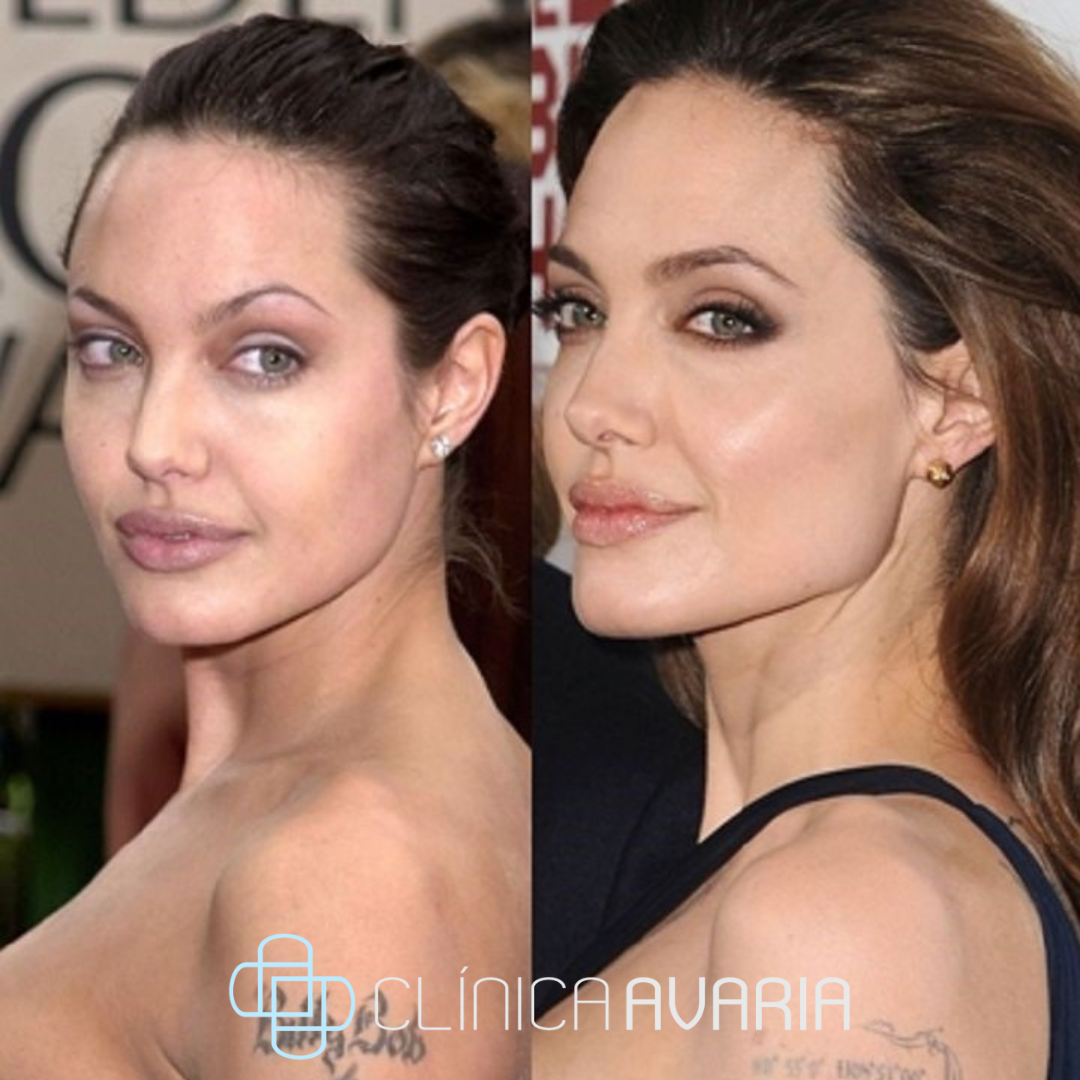 Antes y después de tratamientos de belleza de Angelina Jolie