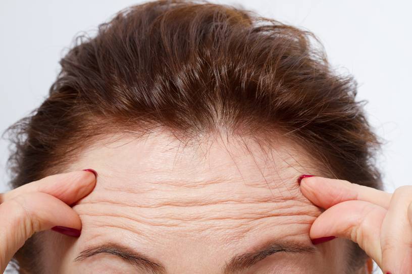 4 errores que hacen que el botox se note