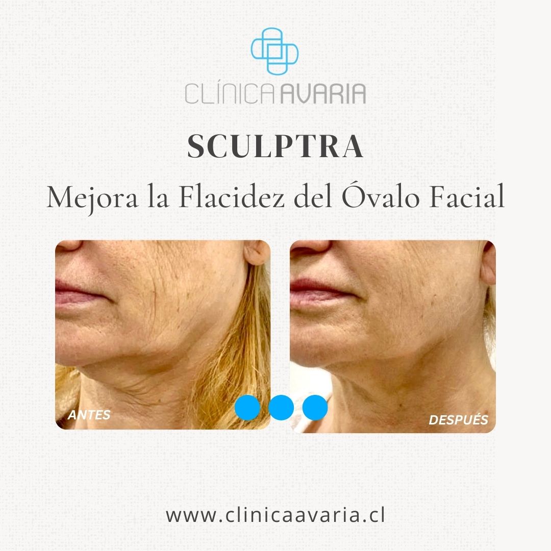 Sculptra antes y después