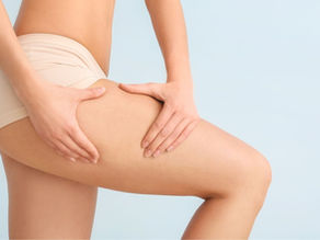 Sculptra en Piernas