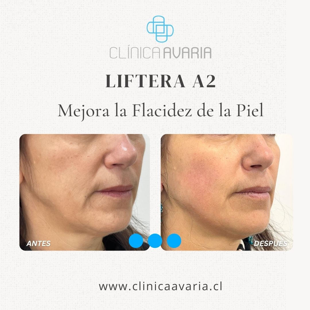 ANTES Y DESPUÉS DE HIFU