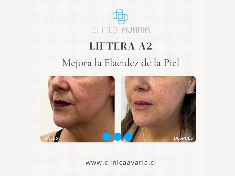 Antes y Después HIFU Liftera